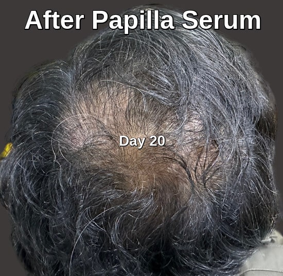 Papilla serum 20 days later
