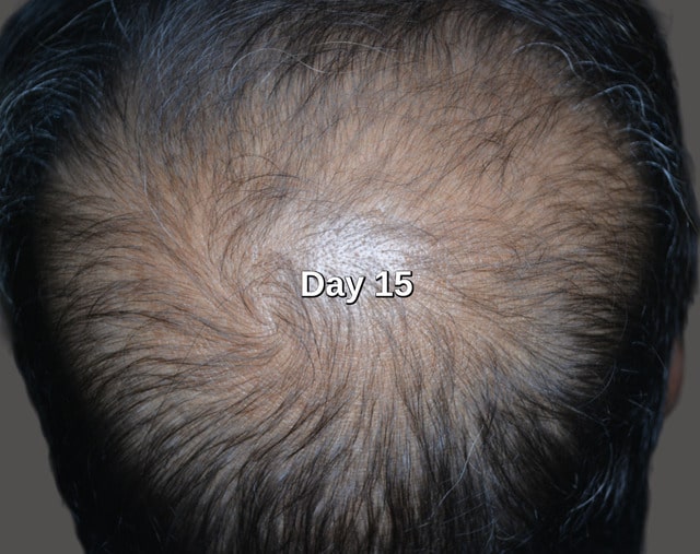 Papilla serum result 15 days later