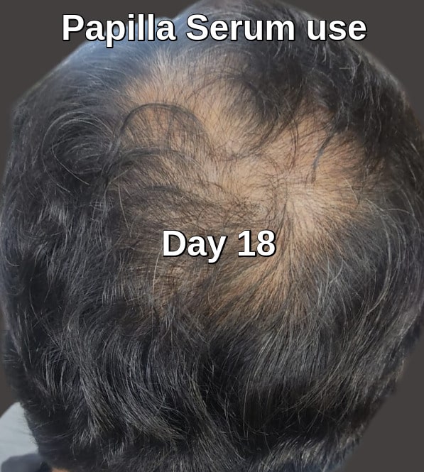 Papilla serum result 18 days later