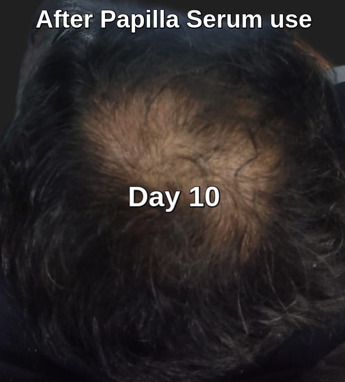 Papilla serum use 10 days later